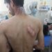 Four Persons Injured In LPG Cylinder Blast In Kupwara