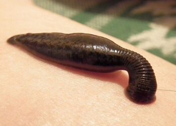 On Navroz, Leech therapy still popular in Kashmir