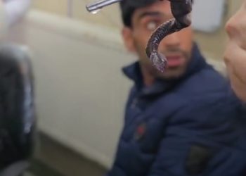 Doctors Remove Snake-Like Worm From Nostril Of An Adolescent Boy In Anantnag