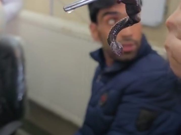 Doctors Remove Snake-Like Worm From Nostril Of An Adolescent Boy In Anantnag