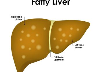 Fatty liver ‘epidemic’ may trigger rise in transplant demand: GMC expert