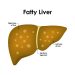 Fatty liver ‘epidemic’ may trigger rise in transplant demand: GMC expert